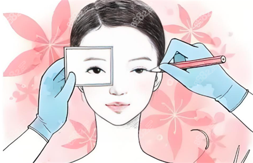 雙眼皮手術(shù)過程 雙眼皮手術(shù)過程