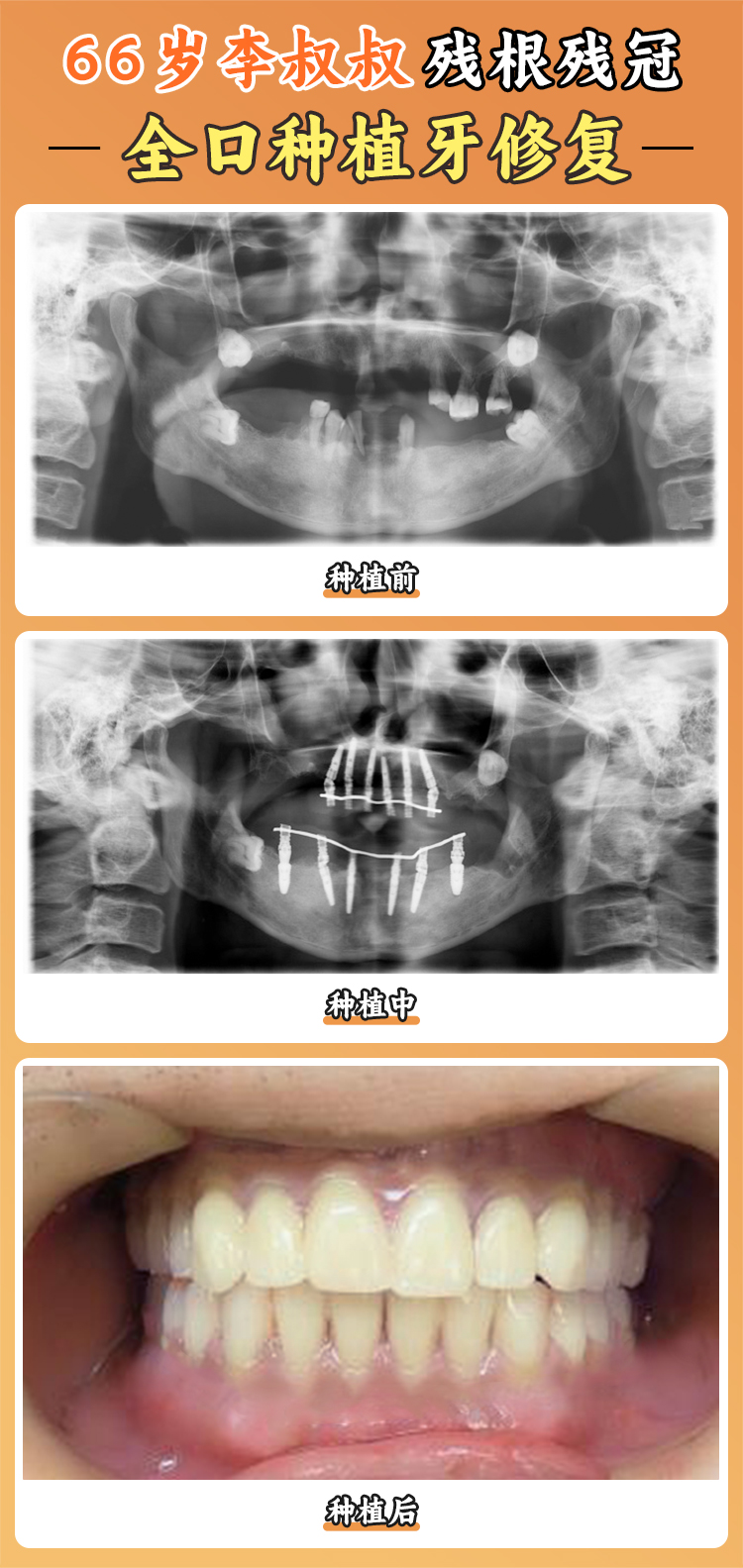 蓬萊種牙寶藏機構(gòu)一，技術(shù)不錯價格優(yōu)