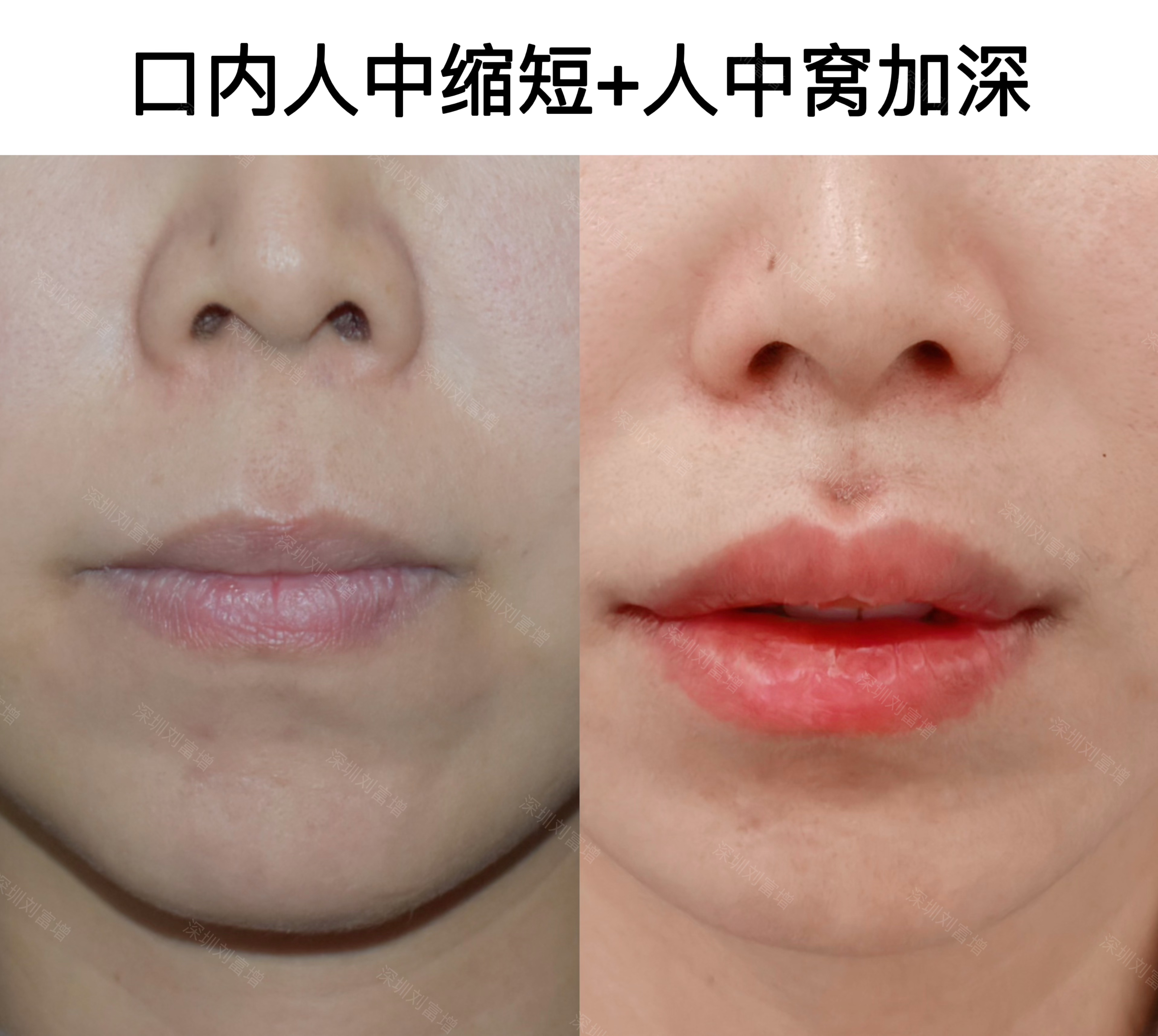 胡俊杰做人中縮短手術(shù)怎么樣？15年經(jīng)驗(yàn)個(gè)性化定制，95%滿意度效果超贊！ 