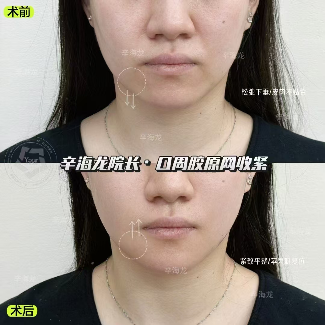 術(shù)后護(hù)理：讓皮膚修復(fù)更理想