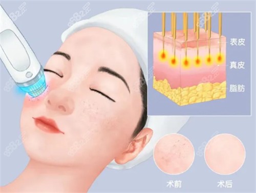 黑曜雙波黃金微針治療層次 黑曜雙波黃金微針治療層次