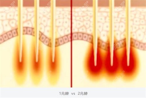 黑曜雙波黃金微針雙波發(fā)射模式 黑曜雙波黃金微針雙波發(fā)射模式