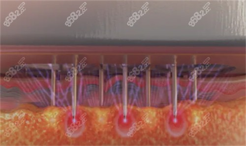 黑曜雙波黃金微針怎么樣 黑曜雙波黃金微針怎么樣