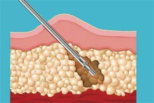 李越FAAS自體脂肪移植怎么樣？北京李越醫(yī)生技術(shù)內(nèi)幕揭秘，真實恢復(fù)案例與手術(shù)費用面診體驗全解析