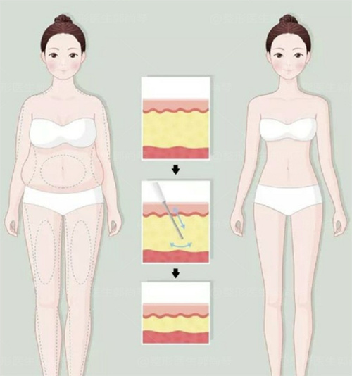 上海九院抽脂價(jià)目表詳細(xì)清單曝光：附真實(shí)案例價(jià)格對比 揭秘隱形消費(fèi)陷阱 讓你花明白錢安心變美