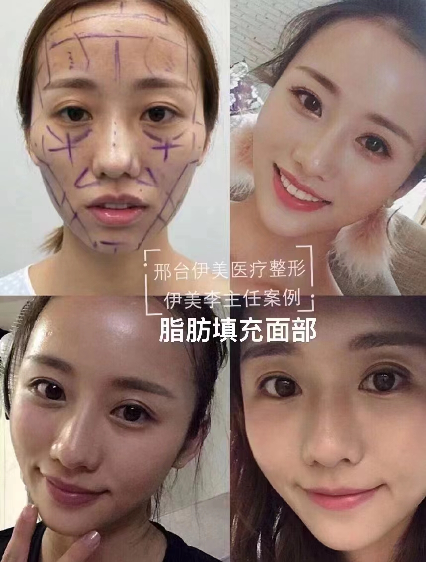 臉部脂肪填充修復專家韋元強預約地址是什么？韋元強口碑好且可在線問診，速來了解！ 