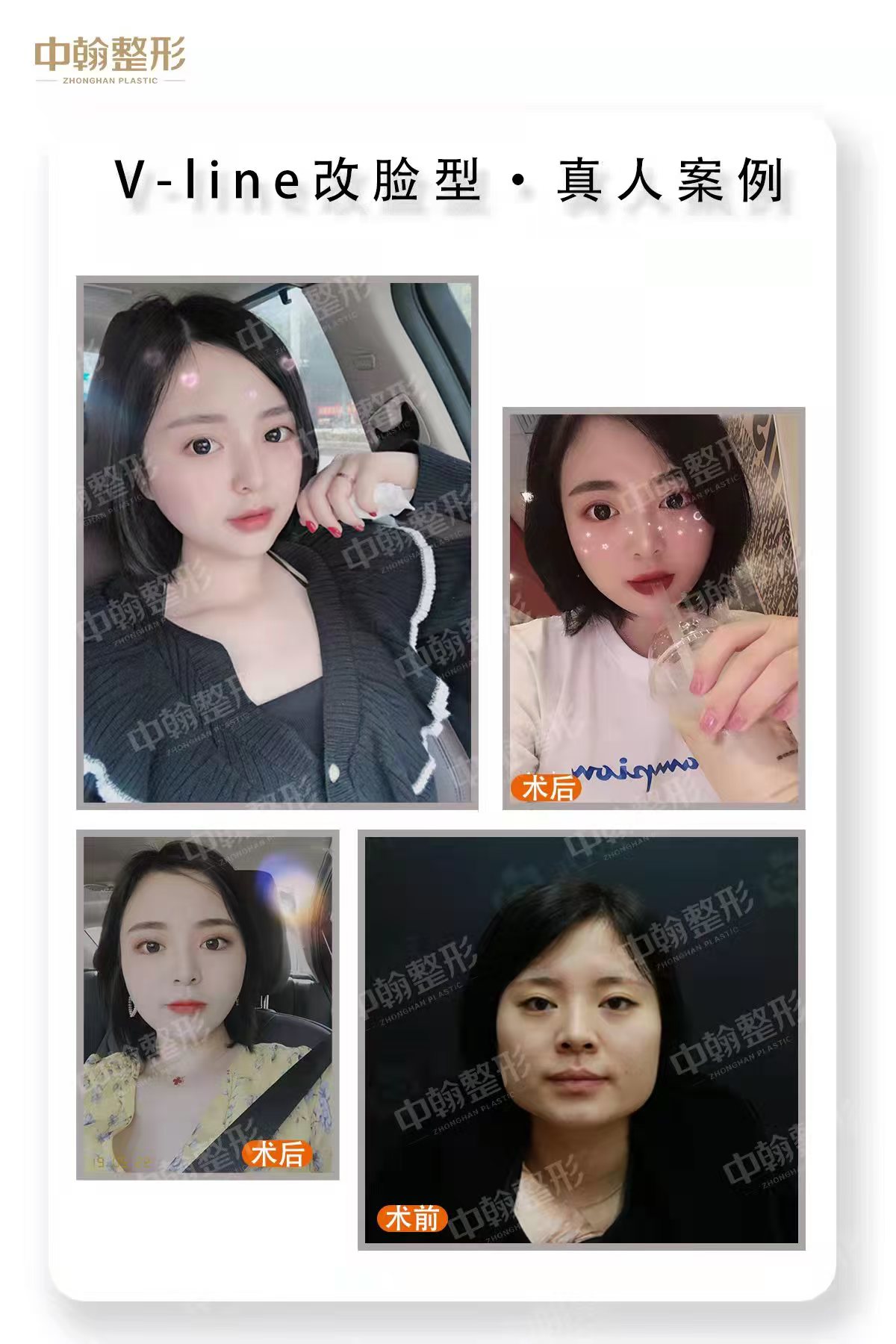 震驚！親歷河南吳勇一針降顴骨，術(shù)后臉型秒變精致小V臉，效果立竿見影太神啦！ 