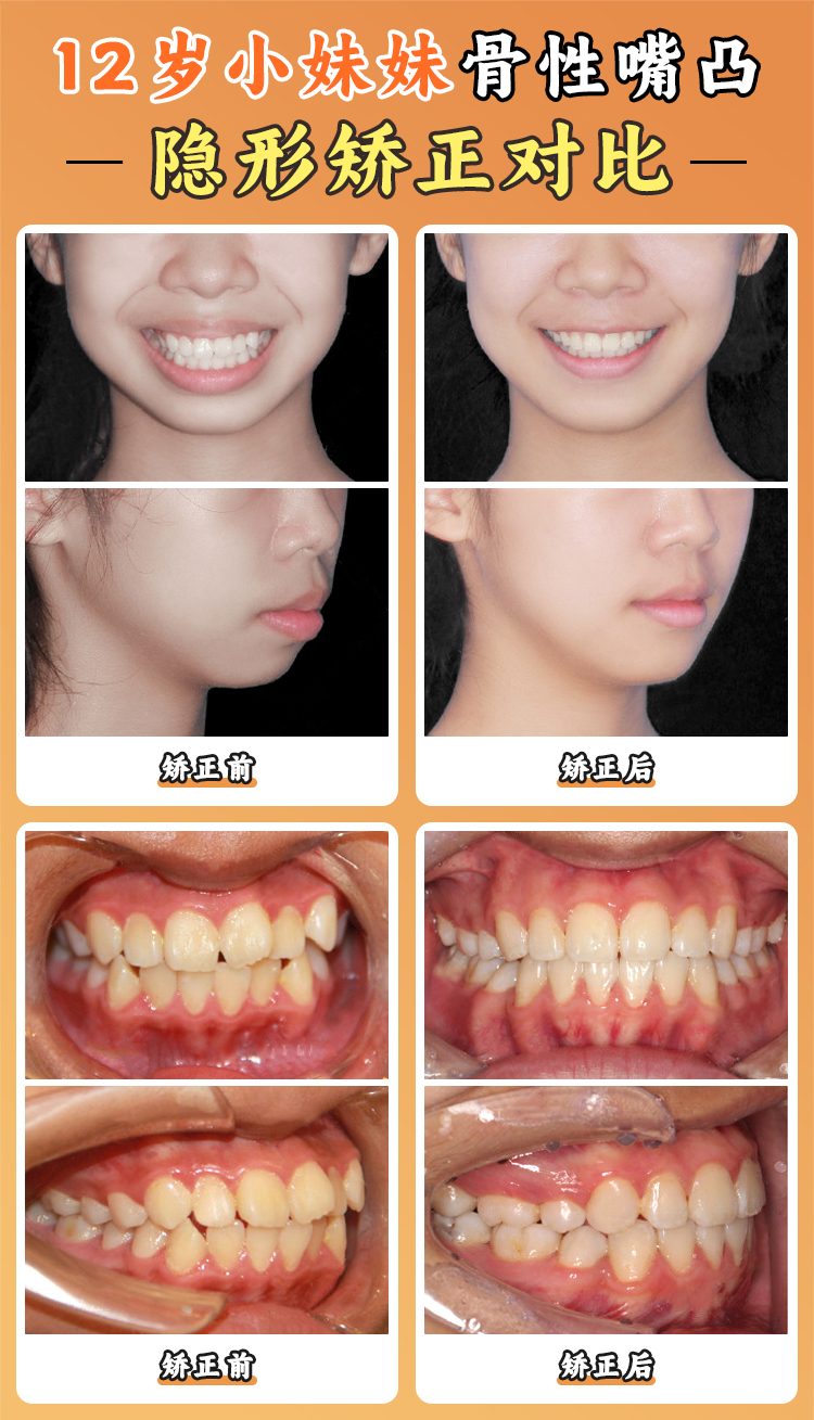 正雅GS版與經(jīng)典版區(qū)別解析：從矯正效果到價格差異，幫你精準選擇隱形牙套