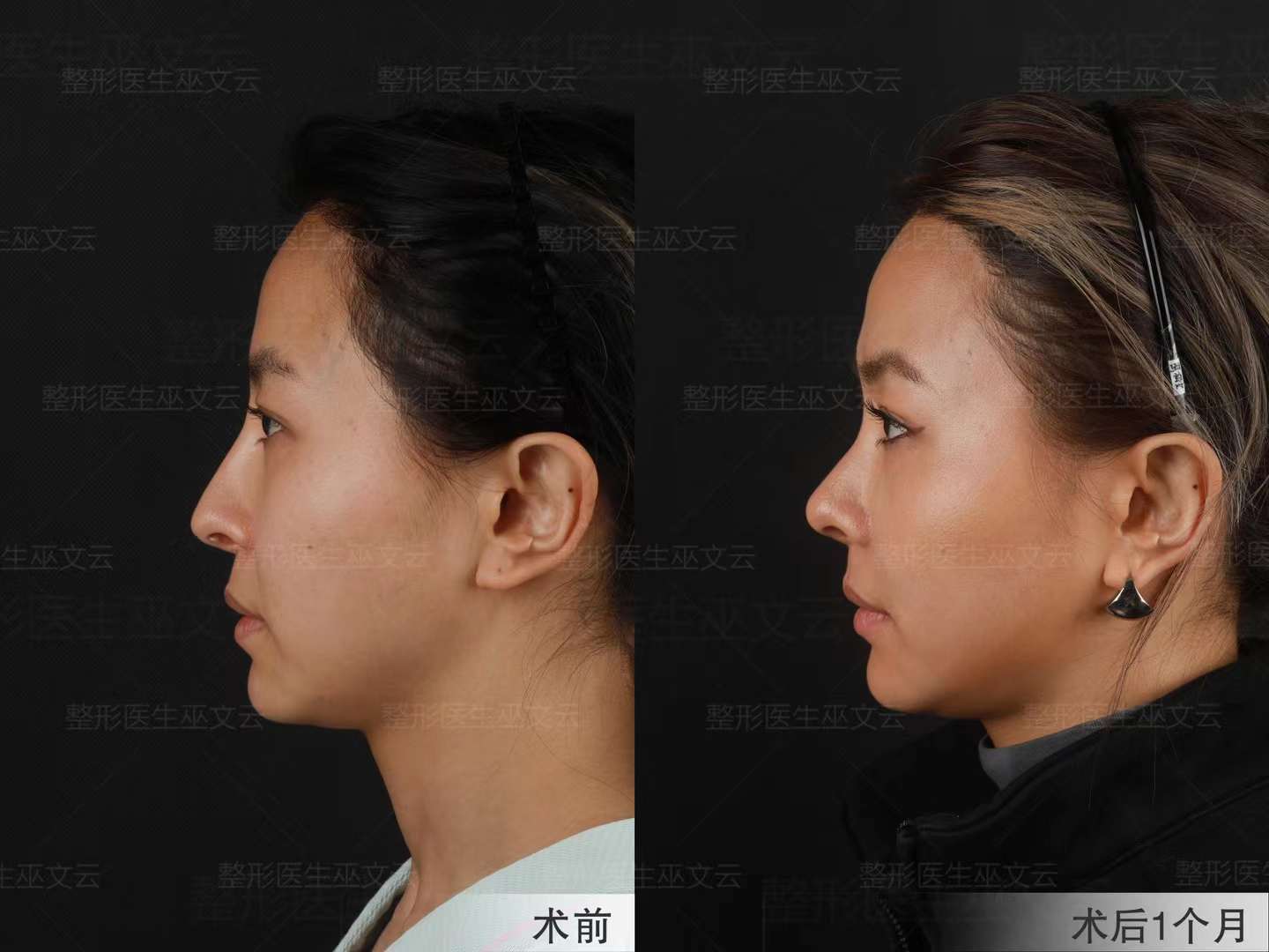 三、巫文云醫(yī)生的技術(shù)實(shí)力與風(fēng)格