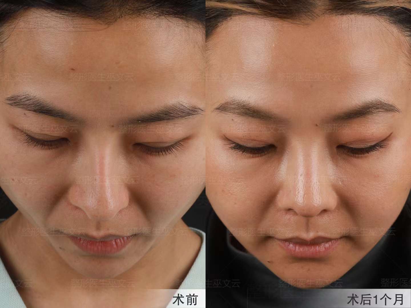 四、巫文云醫(yī)生做鼻子怎么樣？真實(shí)反饋告訴你