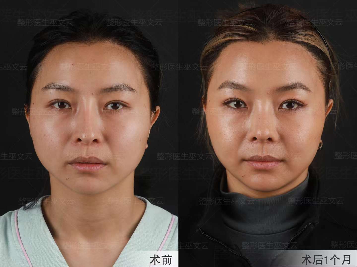 五、巫文云做鼻子價(jià)格表（參考）