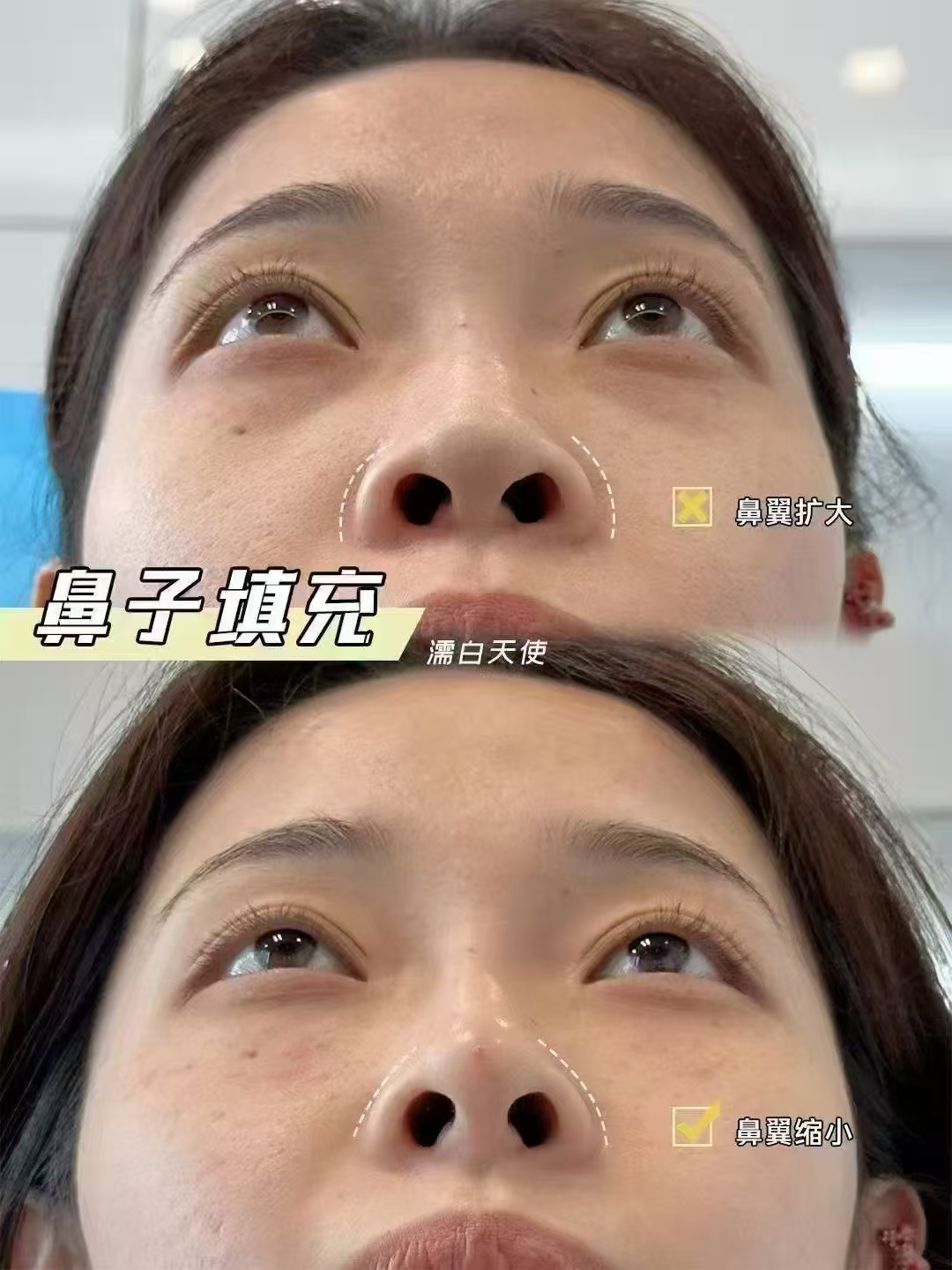 二、孙泽芳医生擅长什么项目：详解“脂肪移植”的技术内核与优势
