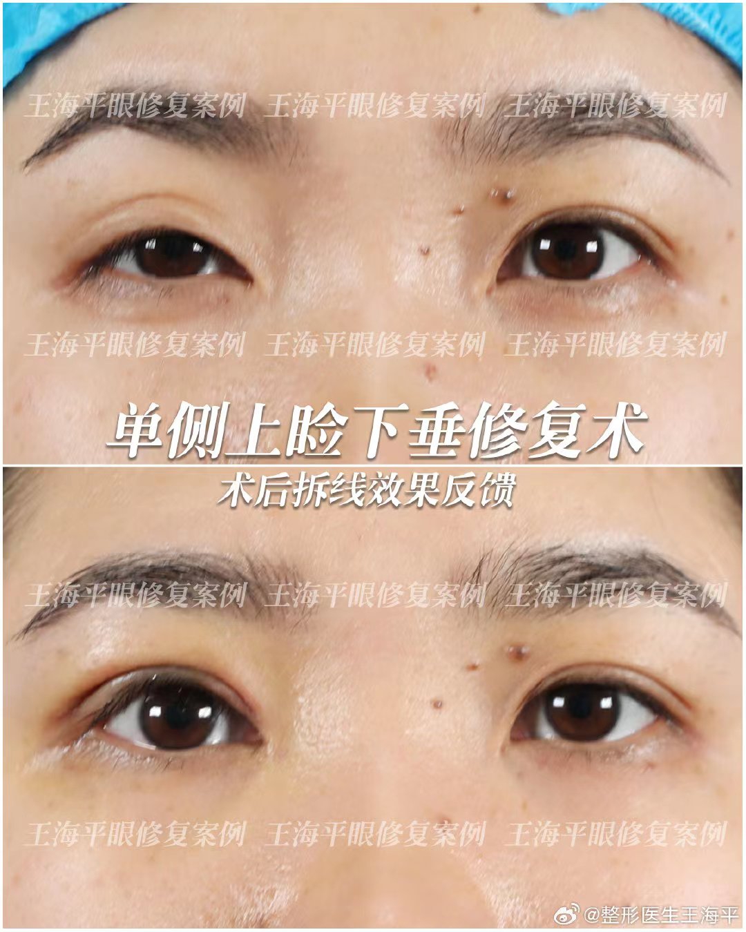 三、脂肪移植豐胸口碑何以建立？——從技術(shù)細節(jié)看價值