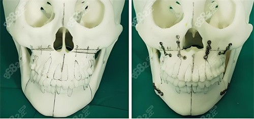 正頜手術手術原理展示圖