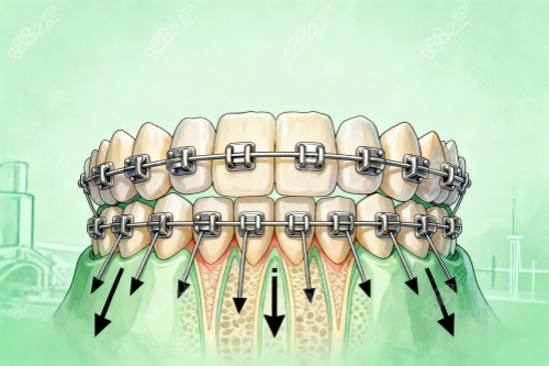 牙齒矯正模型圖片展示