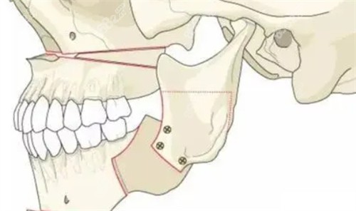 正頜手術后的形狀