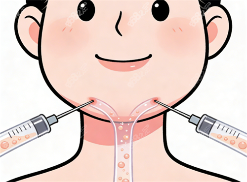 面部吸脂示意圖