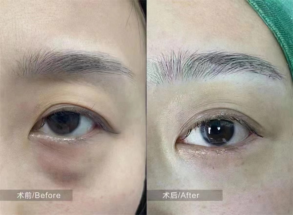 北京紫潔醫(yī)療美容 - 不開刀祛眼袋骨干醫(yī)生