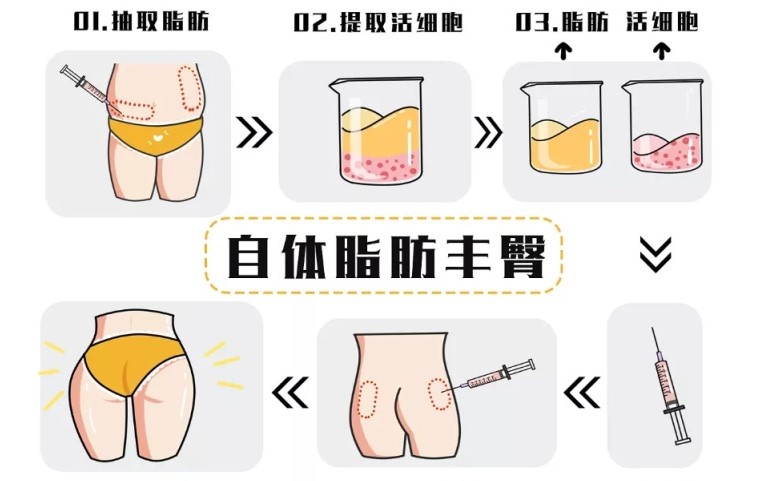 三、怎么用美衛(wèi)士查到北京純脂馮斌脂肪豐胸豐臀真實價格和活動，還能免費預(yù)約