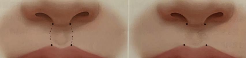 譚拯人中縮短術(shù)后護(hù)理與個(gè)人體質(zhì)影響m.sorencai.cn