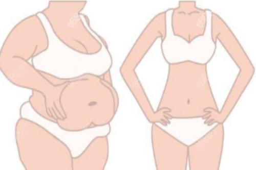 吸脂塑形前后對比圖