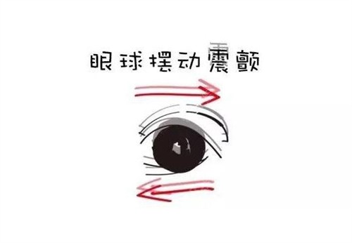 眼球震顫卡通圖展示照片 眼球震顫卡通圖展示照片