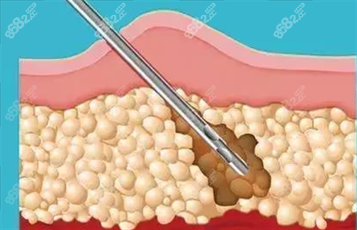 吸脂手術(shù)剖面演示圖