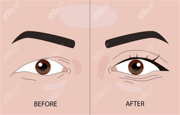 埋線雙眼皮整形