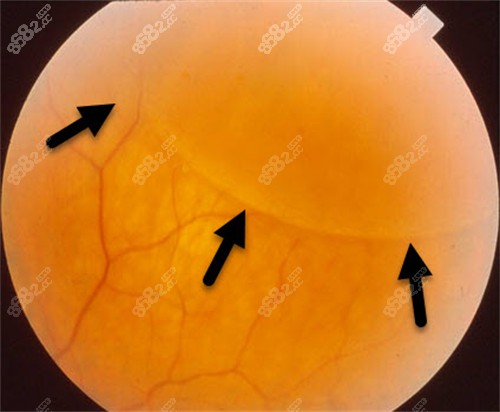 視網(wǎng)膜劈裂圖示