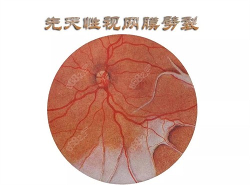 先天性視網(wǎng)膜劈裂圖