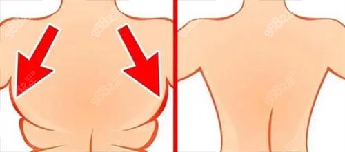 背部吸脂前后動畫對比圖