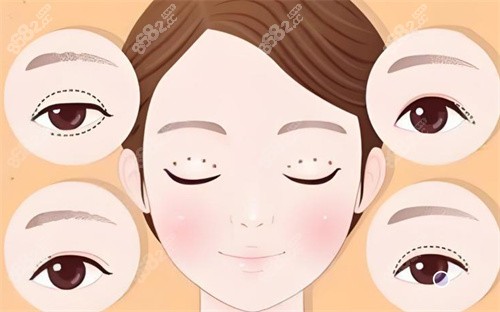 雙眼皮修復(fù)手術(shù)卡通展示圖