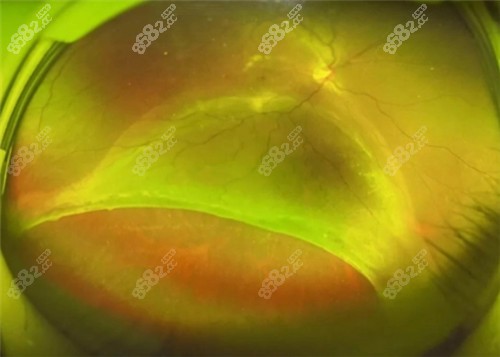 視網(wǎng)膜脫落圖片 視網(wǎng)膜脫落圖片