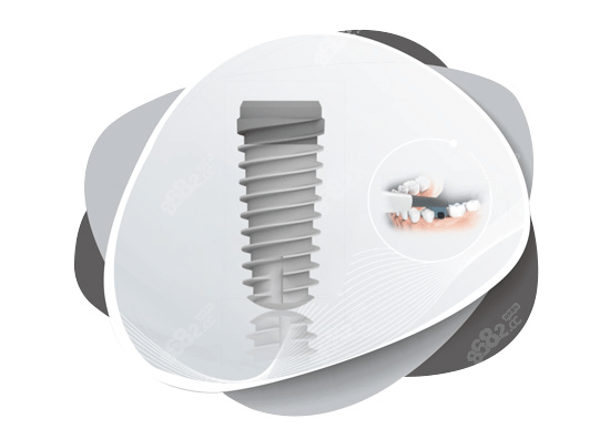 大清西格種植牙照片圖