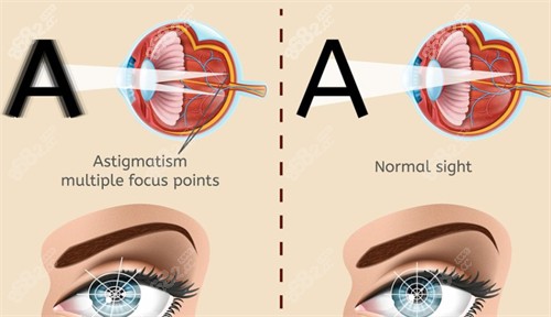 眼球震顫與正常眼睛視物的區(qū)別 眼球震顫與正常眼睛視物的區(qū)別