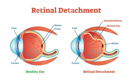 視網(wǎng)膜劈裂對比圖