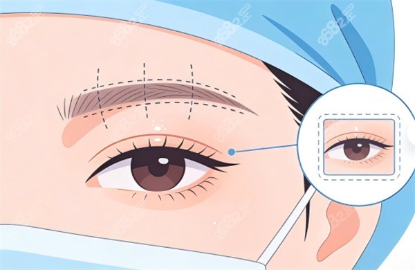 雙眼皮修復(fù)卡通圖片