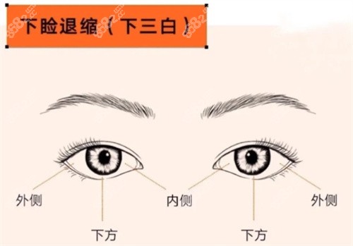 眼修復(fù)下瞼退縮