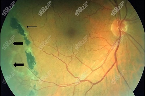 視網(wǎng)膜劈裂演示圖