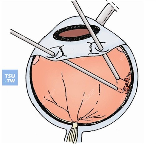 視網(wǎng)膜脫落手術(shù) 視網(wǎng)膜脫落手術(shù)