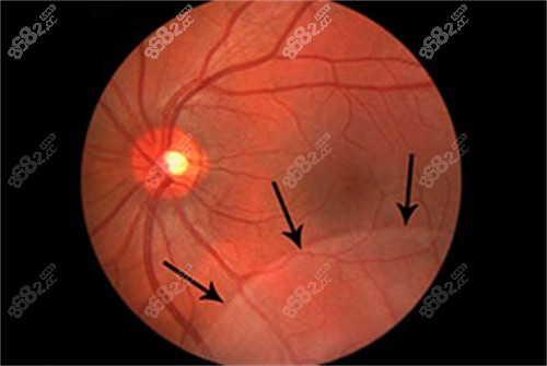 視網(wǎng)膜劈裂手術(shù)展示圖