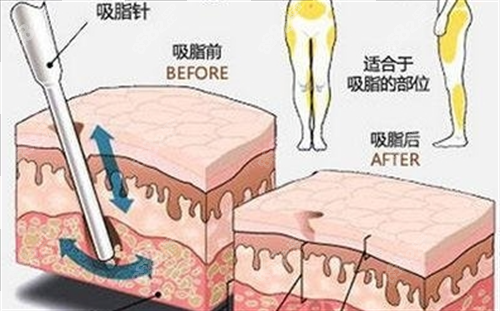 吸脂前后脂肪數(shù)量變化對(duì)比