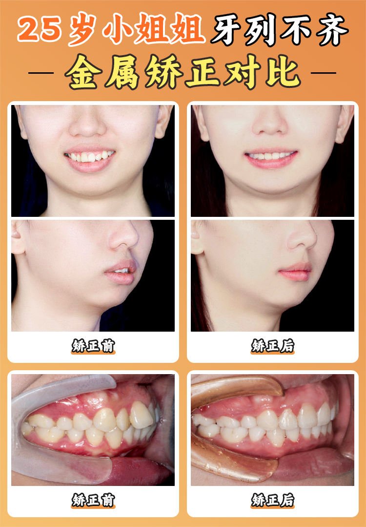 廣州排名好的口腔矯正牙齒醫(yī)院：廣州top5正畸效果好的牙科醫(yī)院