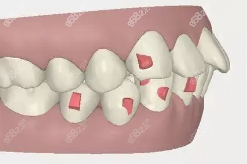 牙齒突出卡通圖 牙齒突出卡通圖