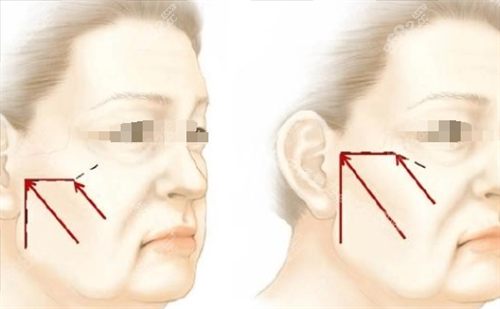 微拉美面部提升方向