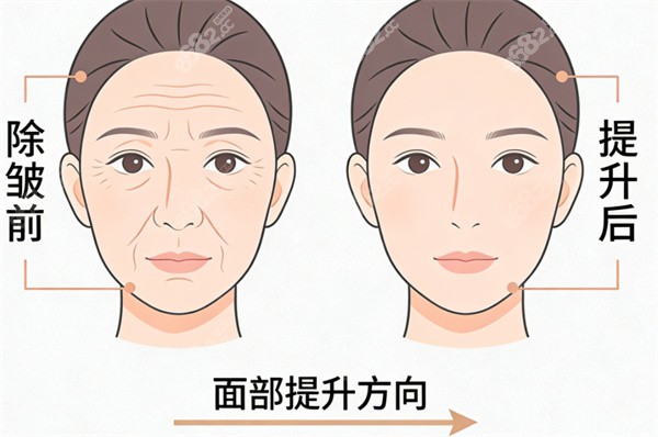 面部提升除皺前后對(duì)比