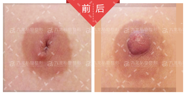 医疗胸带怎么穿长沙祺美肖征刚做胸多少钱？3万起多样假体可选，技术优效果自然_https://www.jmylbn.com_新闻资讯_第2张