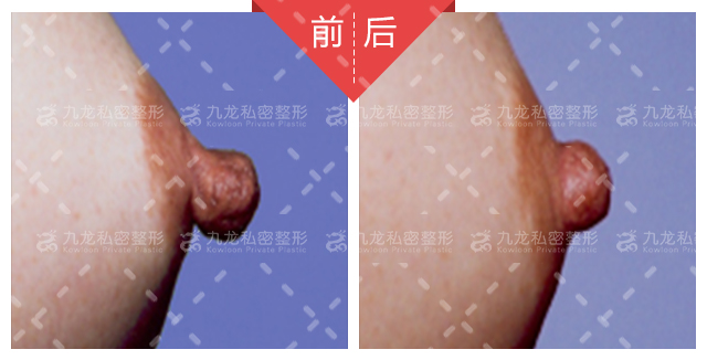 医疗胸带怎么穿长沙祺美肖征刚做胸多少钱？3万起多样假体可选，技术优效果自然_https://www.jmylbn.com_新闻资讯_第1张