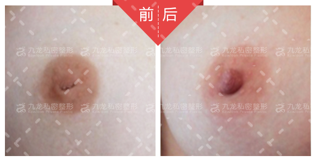 医疗胸带怎么穿长沙祺美肖征刚做胸多少钱？3万起多样假体可选，技术优效果自然_https://www.jmylbn.com_新闻资讯_第4张