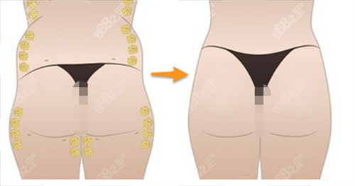 臀部脂肪填充過程展示圖